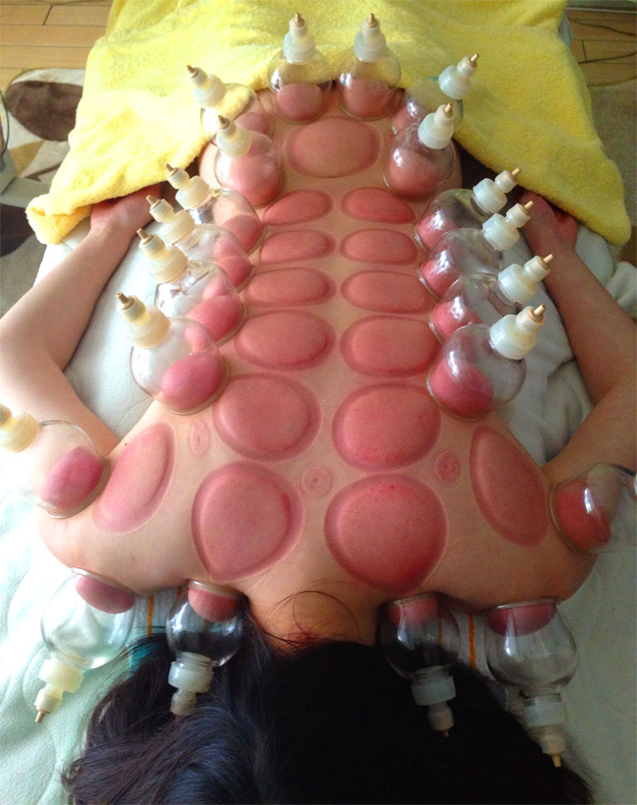 カッピング後の背中